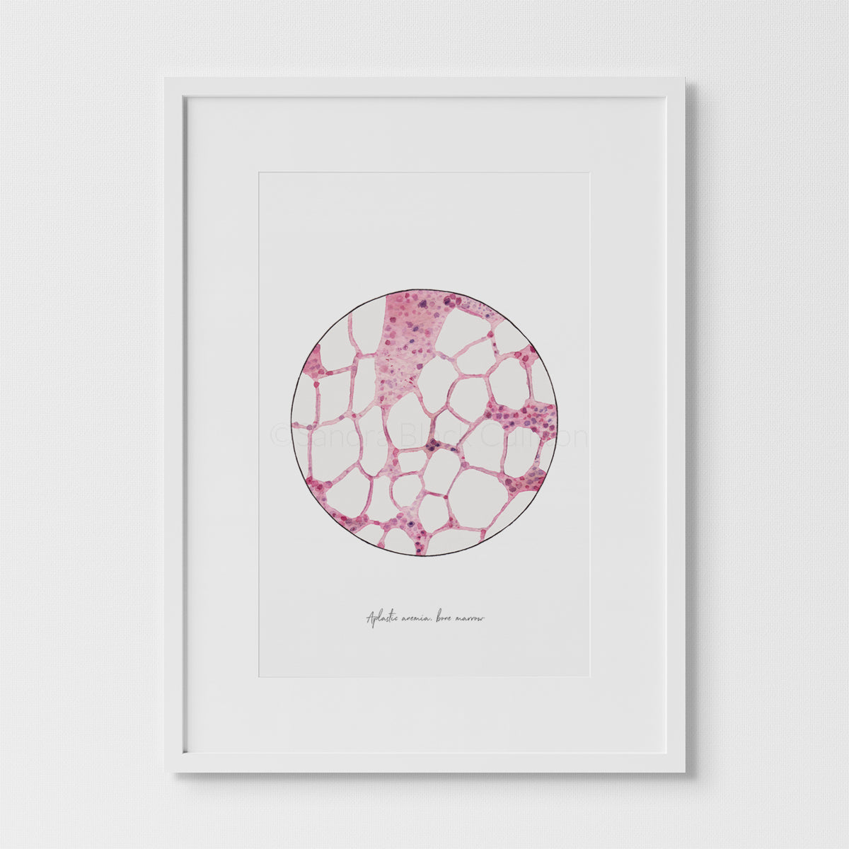 Aplastic anemia in white frame against white background.
