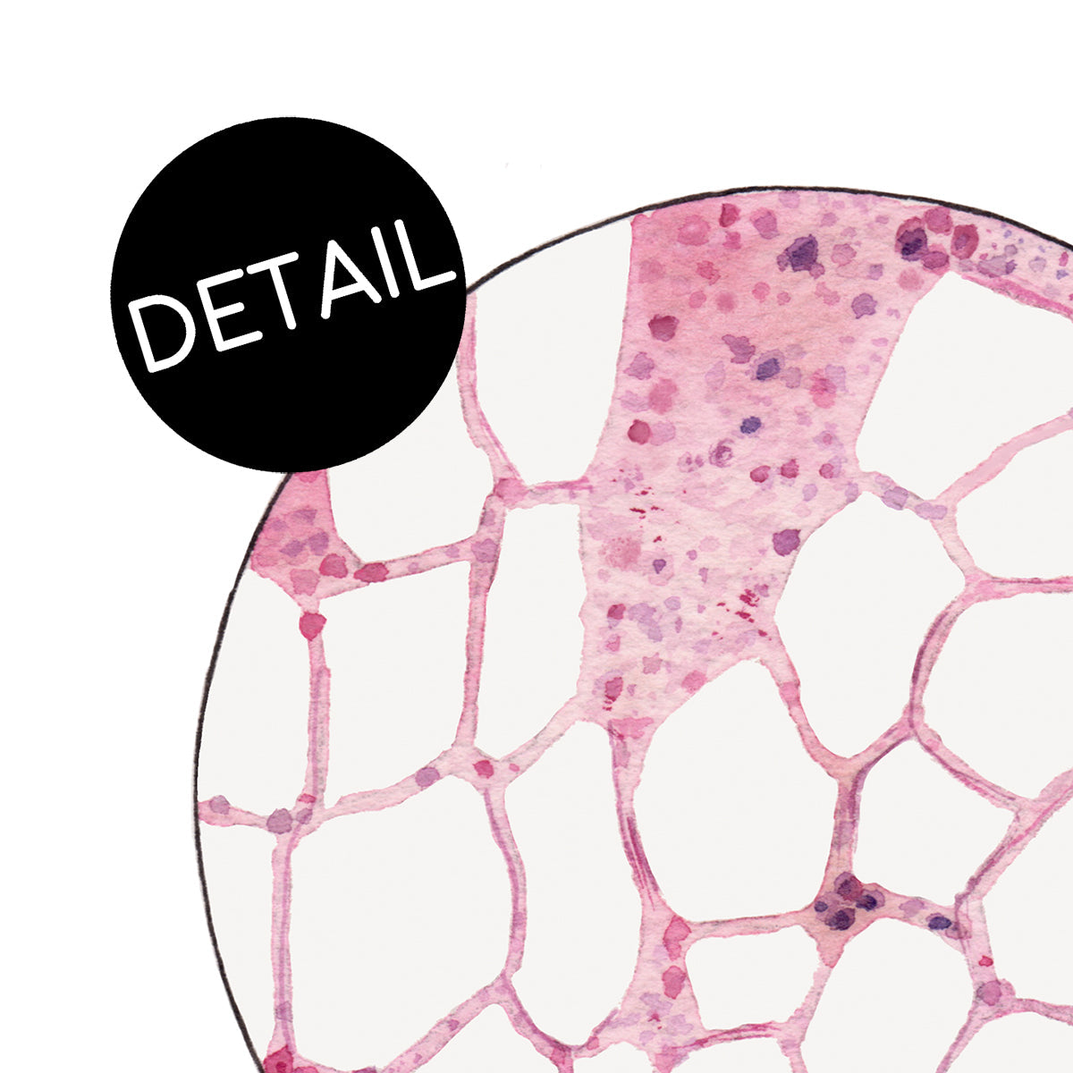 Close up detail of aplastic anemia print.