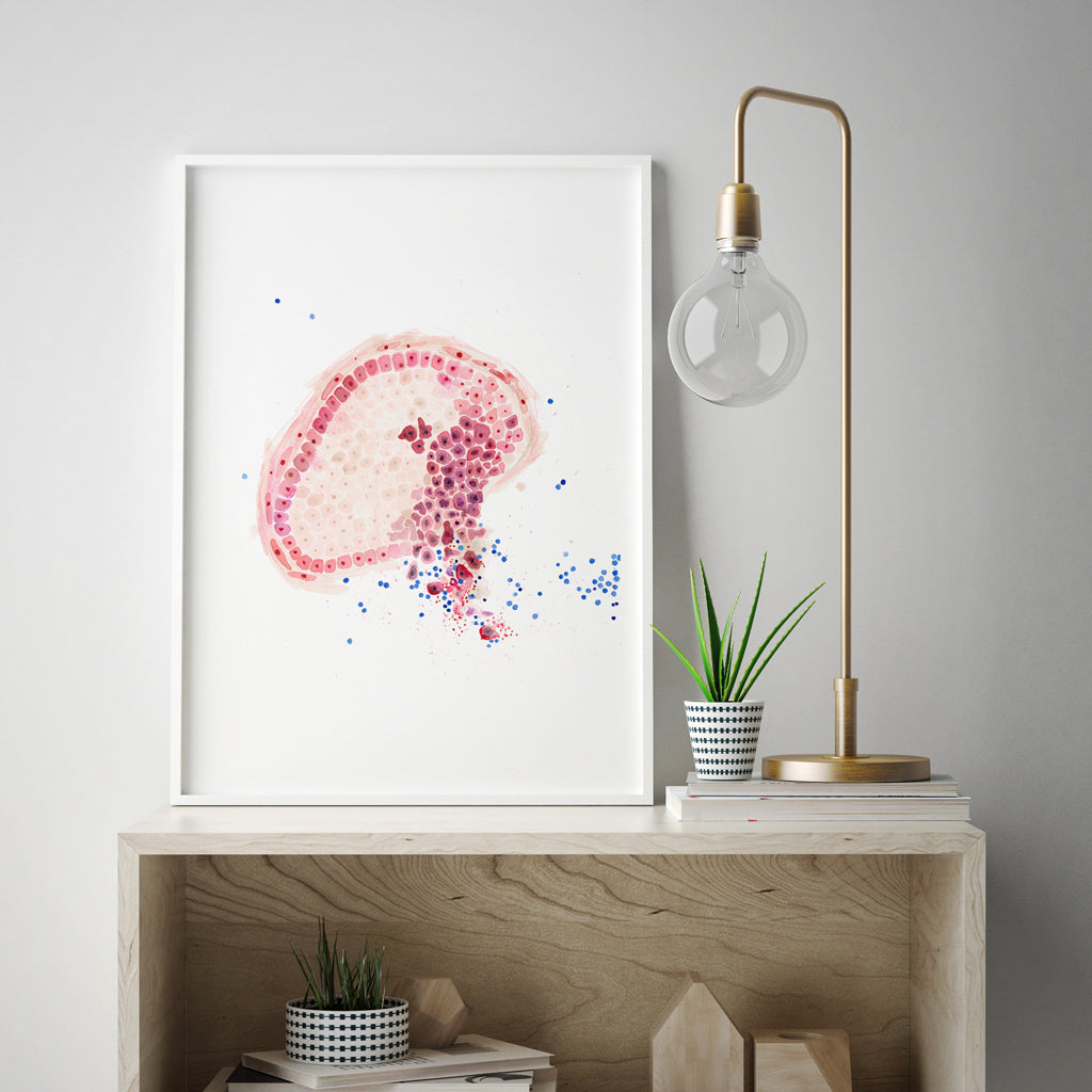 Invasive Ductal Carcinoma,[product type] - Sandra Black Science Art