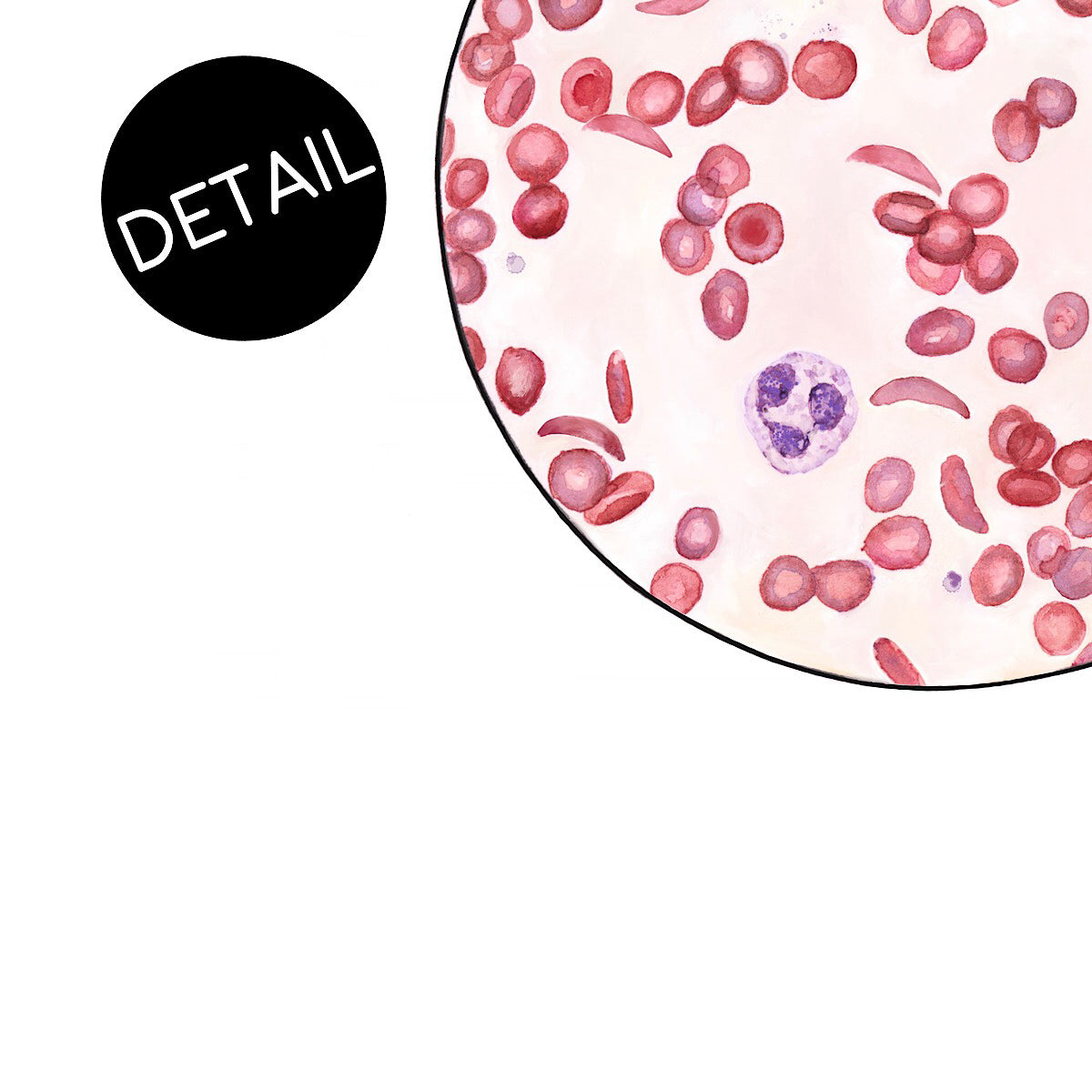 Sickle Cell Anemia,[product type] - Sandra Black Science Art