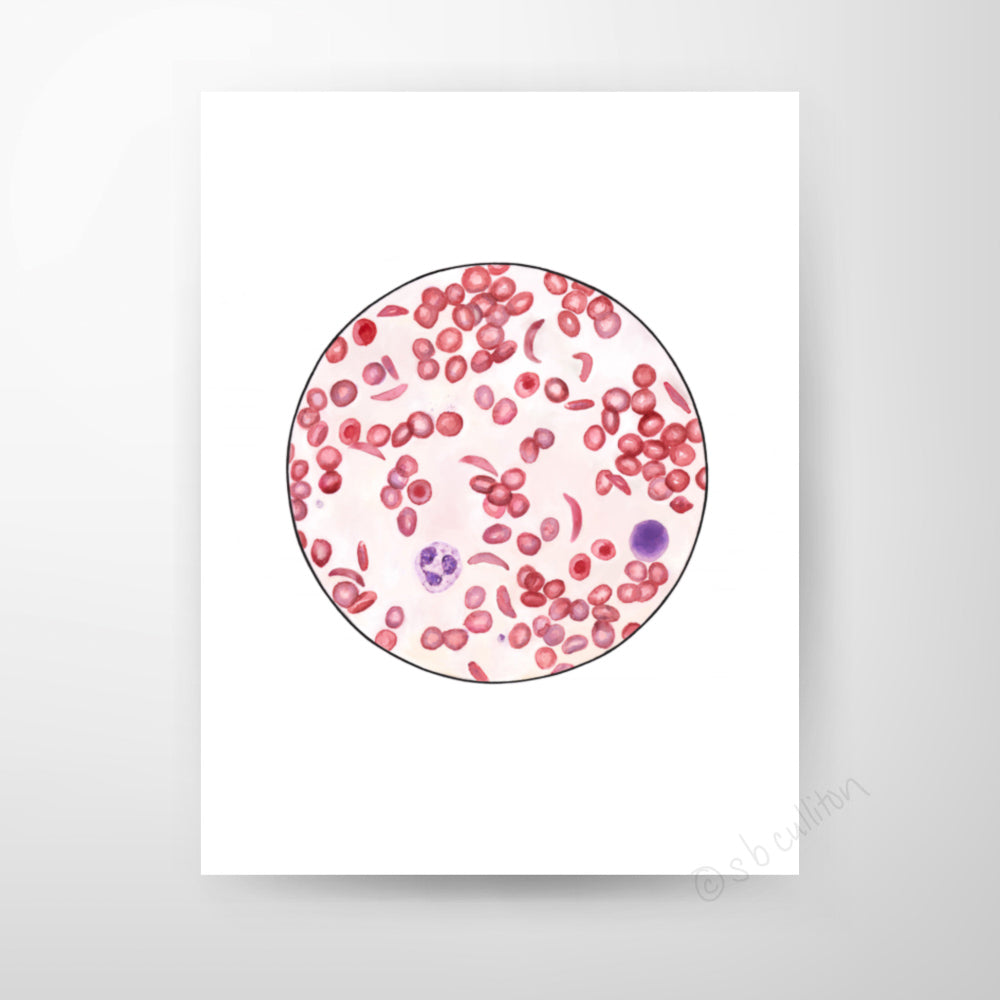 Sickle Cell Anemia,[product type] - Sandra Black Science Art