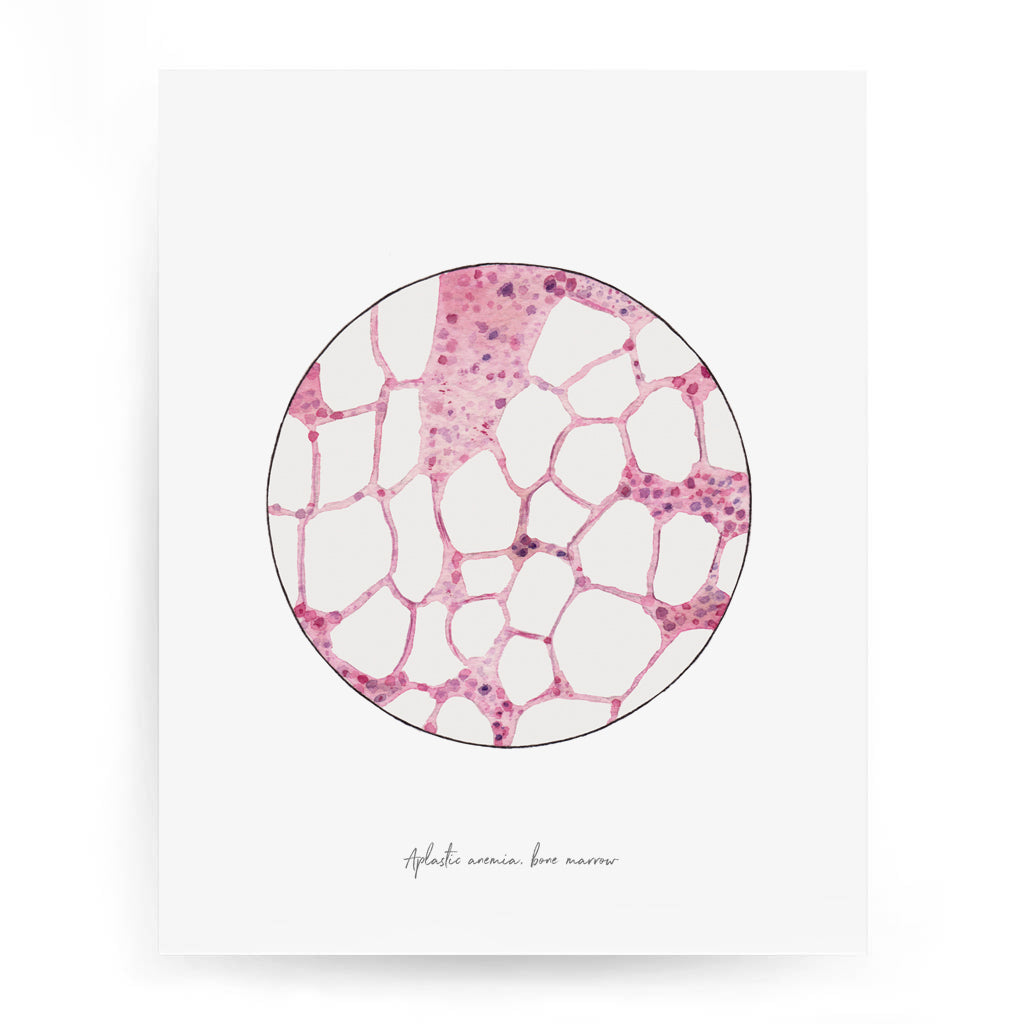 Aplastic anemia watercolor art print