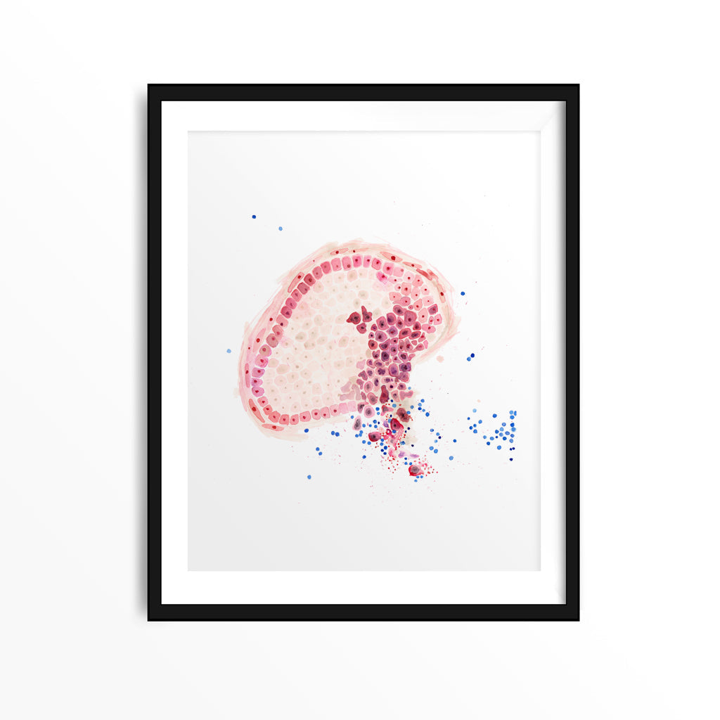 Invasive Ductal Carcinoma,[product type] - Sandra Black Science Art