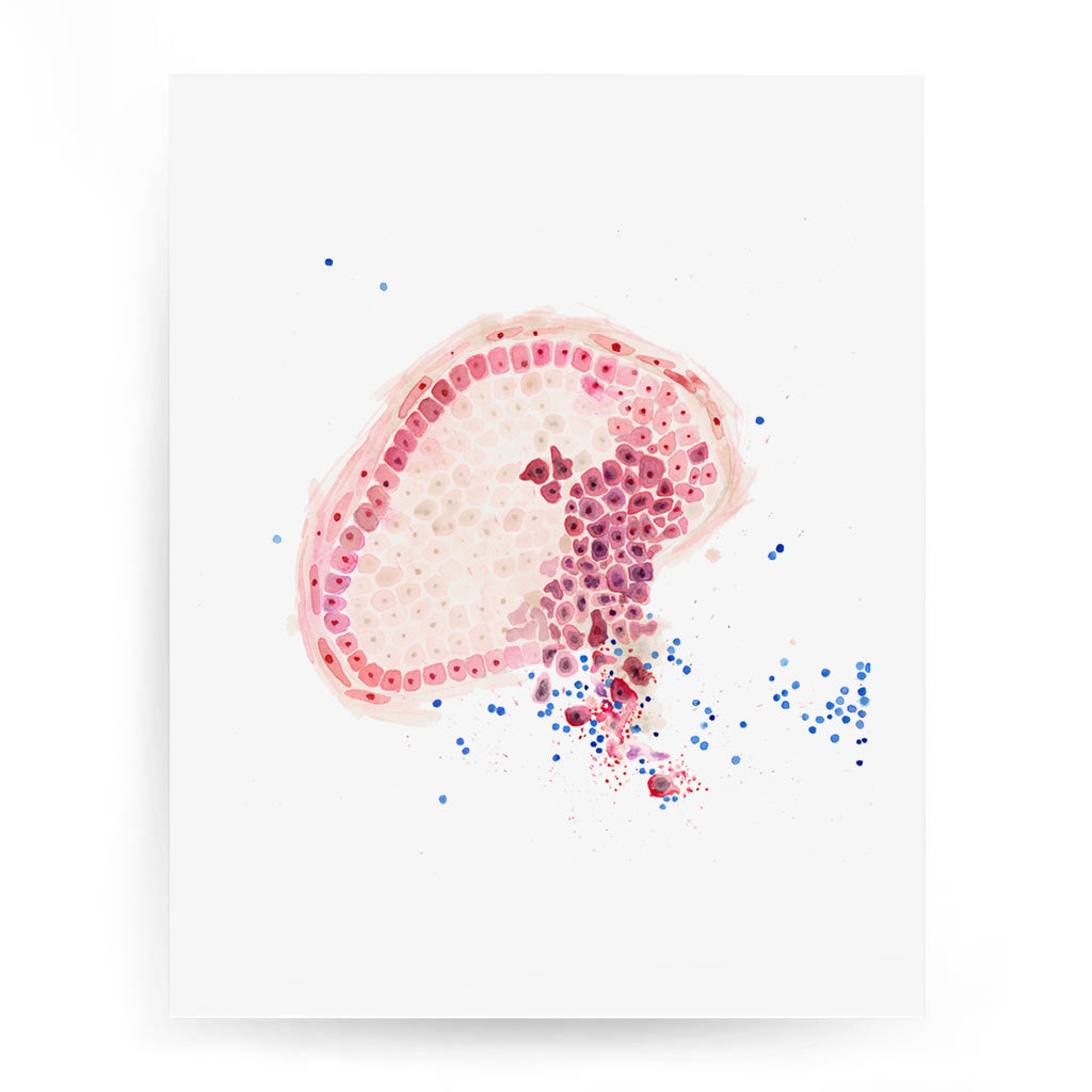 Invasive Ductal Carcinoma,[product type] - Sandra Black Science Art
